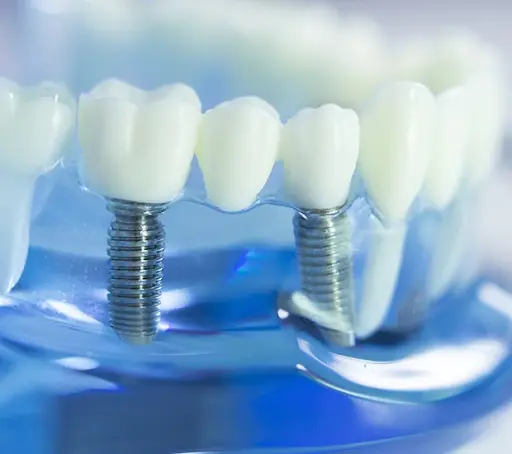 Dental Implants New York, NY